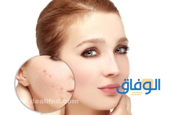 أفضل محلول للحبوب فعال ومجرب+05 أنواع