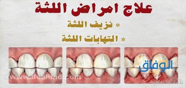 +04 (اقوي علاج لتقوية اللثة) والحفاظ عليها | صحية وسليمة - موقع الوفاق اقوي علاج لتقوية اللثة
