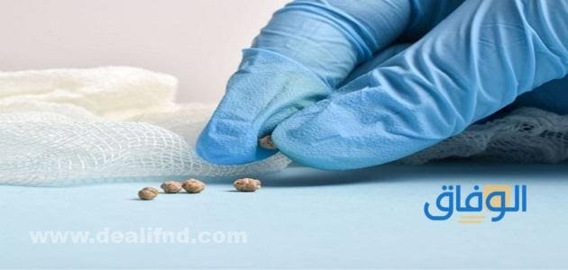 تفتيت حصى المرارة