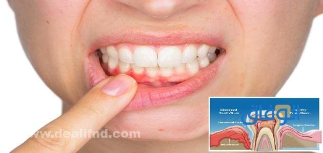 +04 (اقوي علاج لتقوية اللثة) والحفاظ عليها | صحية وسليمة - موقع الوفاق علاج اللثة باستخدام البابونج والخل والقرفة