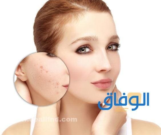 افضل محلول للحبوب | الصيدليات +05 أنواع مجربة ومضمونة