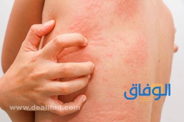 +05 أنواع كريم للحساسية والحكّة | مجربة ومضمون