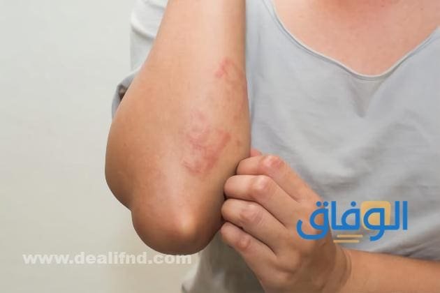 +05 أنواع كريم للحساسية والحكّة | مجربة ومضمون كريم للحساسية والحكّة