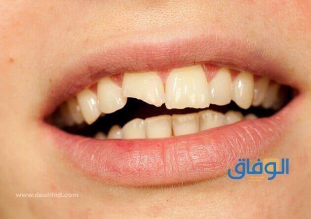 تفسير حلم كسر السن | دلالاتة في كل الحالات