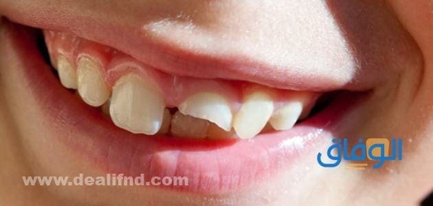 تفسير حلم تكسر الأسنان