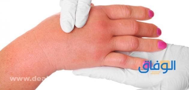 طرق علاج الأملاح في الجسم | مشروبات للتخلص من الأملاح الزائدة علاج الأملاح في الجسم