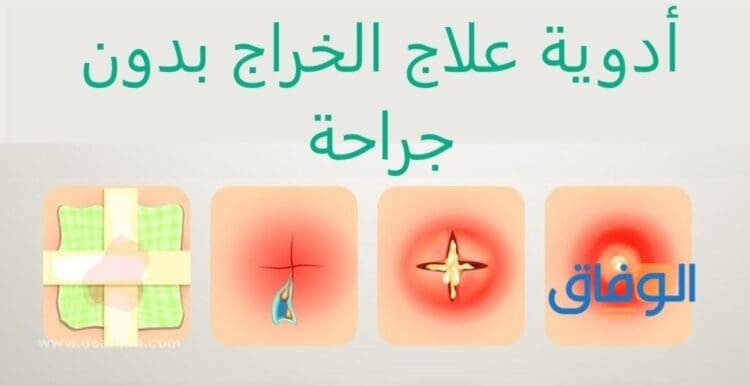 علاج الخراج – +10 طرق للتخلص منه في المنزل