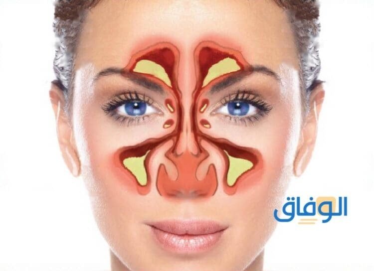 علاج الجيوب الأنفية – +10 طرق ستخلصك من ألم الجيوب الأنفية نهائيًا