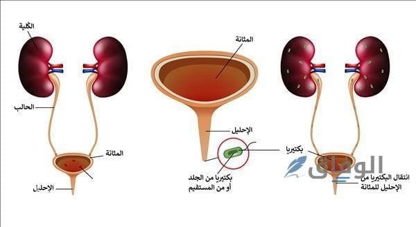 أعراض التهاب المسالك البولية.. | الأسباب وطرق العلاج