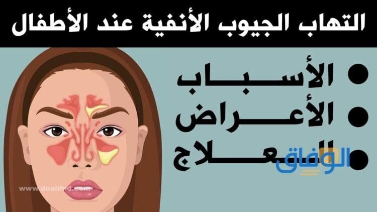 علاج التهاب الجيوب الأنفية – أقوى 5 طرق للقضاء عليها بسرعة