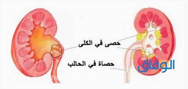 اعراض حصى الكلى + الأسباب وطرق العلاج