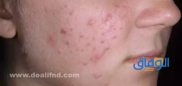 اسباب ظهور حبوب الوجه