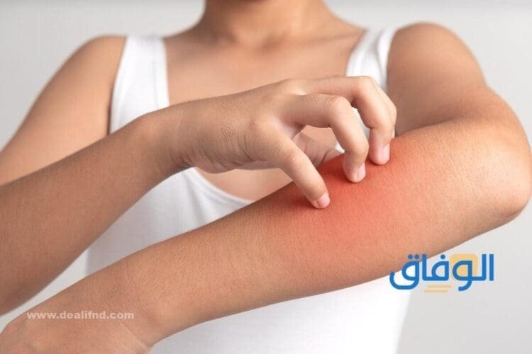 علاج الحساسية الجلدية