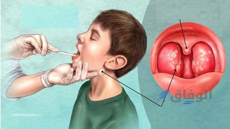 أعراض التهاب الحلق الفيروسي 