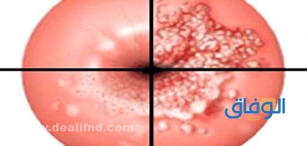 اعراض قرحة الرحم + الأسباب وطرق الوقاية والعلاج