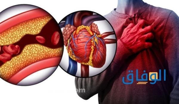 اعراض ارتفاع الكولسترول وأسبابه | +05 طرق فعالة للوقاية اعراض ارتفاع الكولسترول