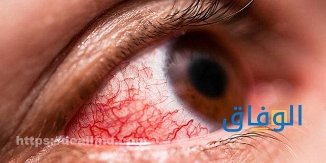 أبرز+10 اسباب احمرار العين | طرق العلاج والوقاية 2024