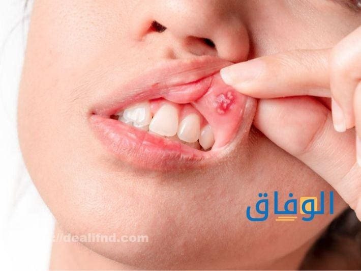 اسباب تقرحات الفم | أفضل 5 طرق منزلية لعلاج قرح الفم أعراض تقرحات الفم