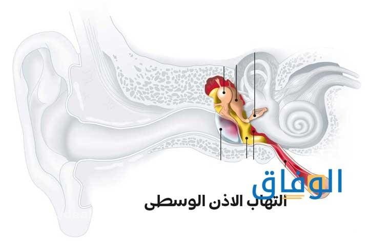 اعراض الاذن الوسطى | أسباب التهاب الأذن الوسطى وعلاجها طرق علاج الأذن الوسطى طبيعيًا