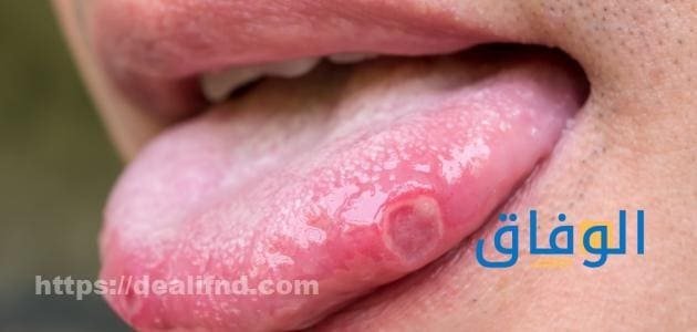 اسباب تقرحات الفم | أفضل 5 طرق منزلية لعلاج قرح الفم العلاجات الموضعية لتقرحات الفم