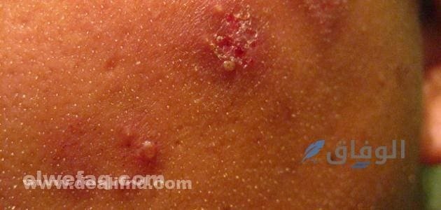 الحزام الناري بالصور | الأسباب والأعراض وطرق العلاج؟ أعراض الحزام الناري
