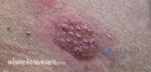 الحزام الناري بالصور | الأسباب والأعراض وطرق العلاج؟ أسباب الإصابة ب الحزام الناري