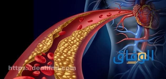 اعراض ارتفاع الكولسترول وأسبابه | +05 طرق فعالة للوقاية