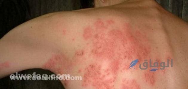 الحزام الناري بالصور | الأسباب والأعراض وطرق العلاج؟ كيف يتم تشخيص الحزام الناري