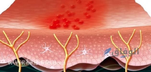 الحزام الناري بالصور | الأسباب والأعراض وطرق العلاج؟ علاج الحزام الناري