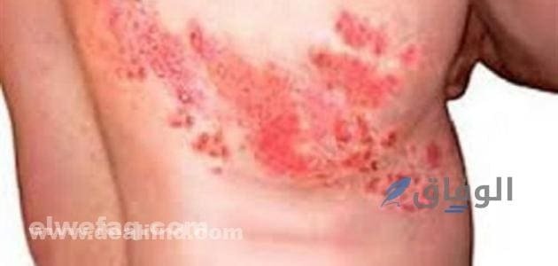 الحزام الناري بالصور | الأسباب والأعراض وطرق العلاج؟ الحزام الناري بالصور
