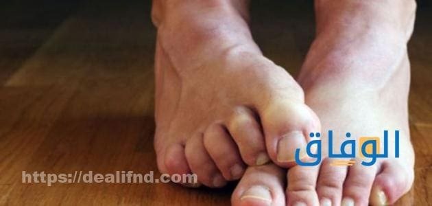 اعراض نقص المغنسيوم وأسبابه | +05 طرق فعالة لمقاومة نقص Mg