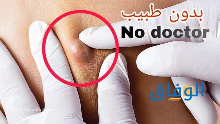 علاج الخراج بالبصل