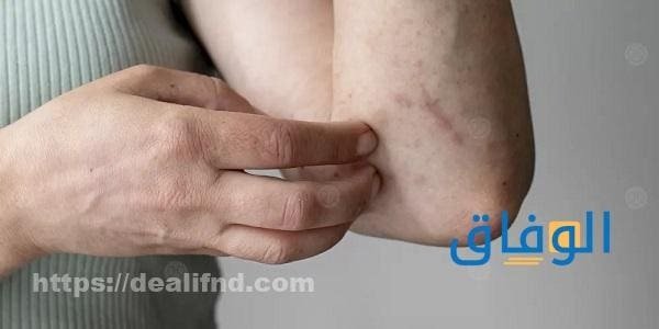 أبرز أعراض التهاب الجلد التماسي وطرق العلاج