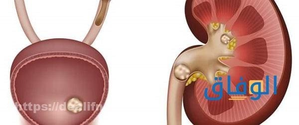 ما هي أعراض حصوات الكلى، أسبابها، وطرق علاجها؟