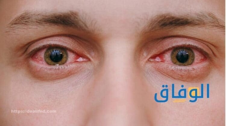 أعراض ضغط العين