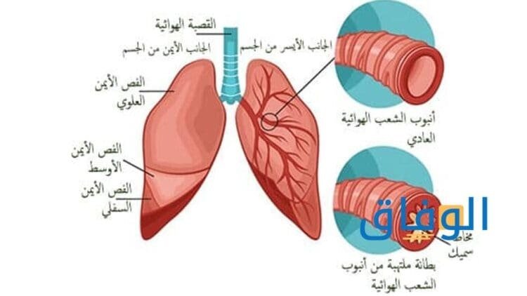 التهاب الشعب الهوائية|+4 طرق للوقاية منها لم تتوقعها!