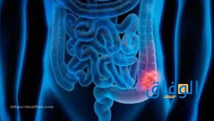 أسباب القولون العصبي