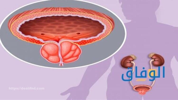 أعراض التهاب البروستاتا | +3 طرق لعلاج التهاب البروستاتا