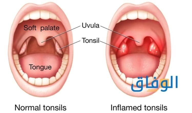 أعراض التهاب الحلق