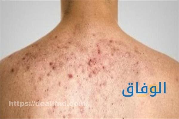 أفضل كريم لحبوب الجسم
