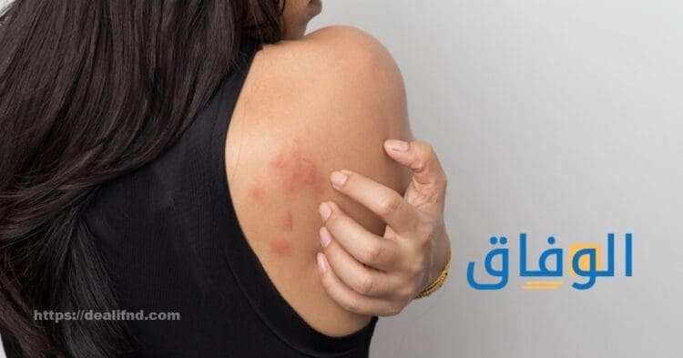 افضل حبوب حساسية الجلد|+ 10 ادوية