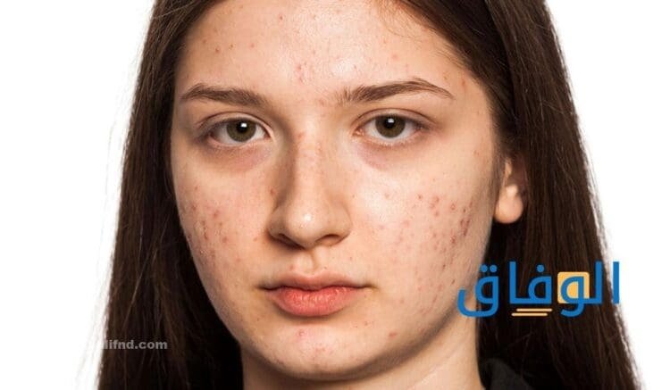 أسباب حبوب الوجه