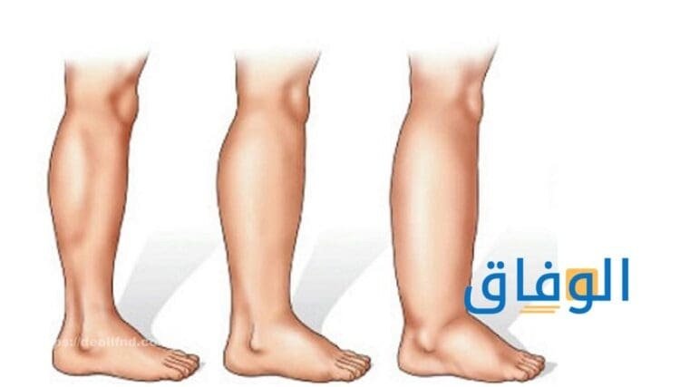 أعراض احتباس السوائل | أهم المشروبات لتقليل احتباس السوائل