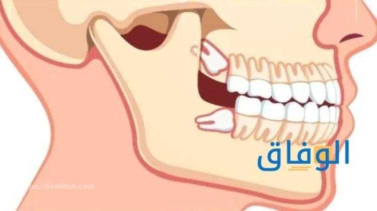 أعراض ضرس العقل | أهم مضاعفات ضرس العقل المدفون