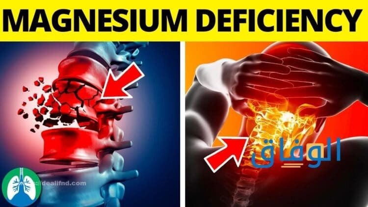 أعراض نقص مغنيسيوم | + 4 أساليب للعلاج