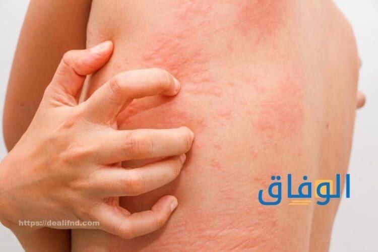أفضل كريم للحساسية والحكة | افضل 10 كريمات ننصح بها