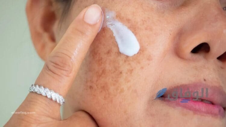 كريمات لعلاج التصبغات
