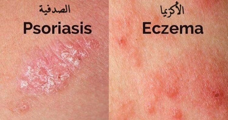 الفرق بين الاكزيما والصدفية: ما لا تعرفه عن الفروق!