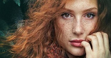 اطمن.. 5 علامات جلدية لا قلق منها أبرزها النمش